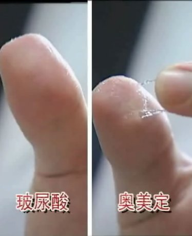 折磨了我这么多年的奥美定终于取出来了
