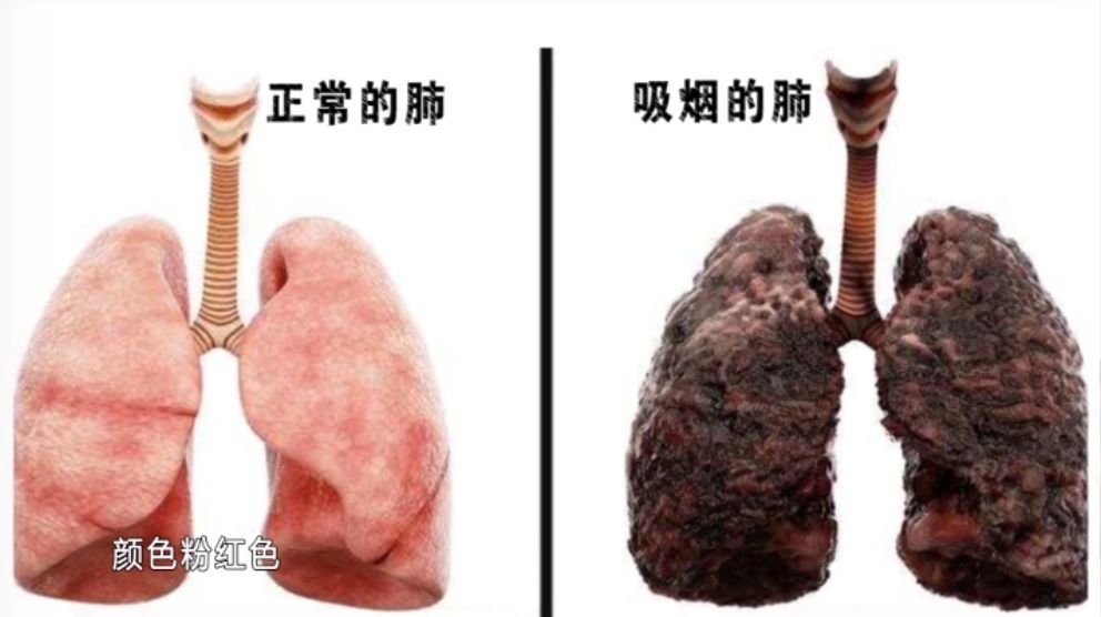 吸烟肺的变化过程图片