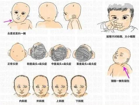 发现孩子斜颈怎么办?斜颈宝宝的治疗,越早开始介入越好!