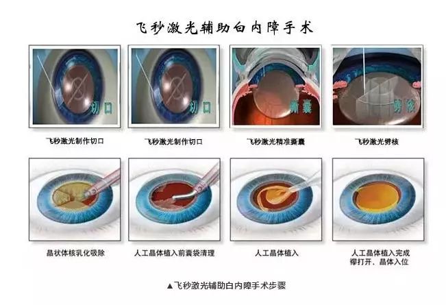 小切口白内障手术图解图片