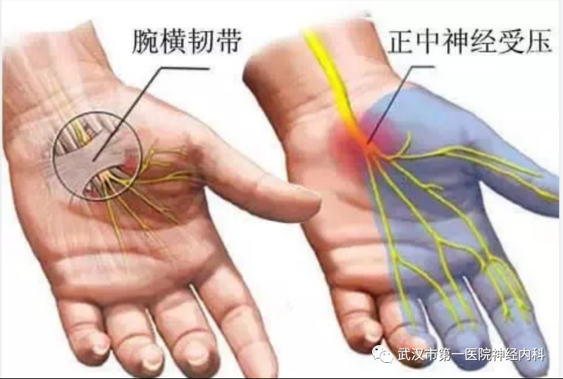 "腕管综合征"又叫"鼠标手",是最常见的周围神经卡压性疾病.