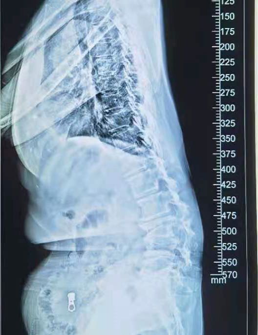经过检查,胡先生被确诊为腰椎后凸畸形,并伴有一定程度的侧弯和腰椎管