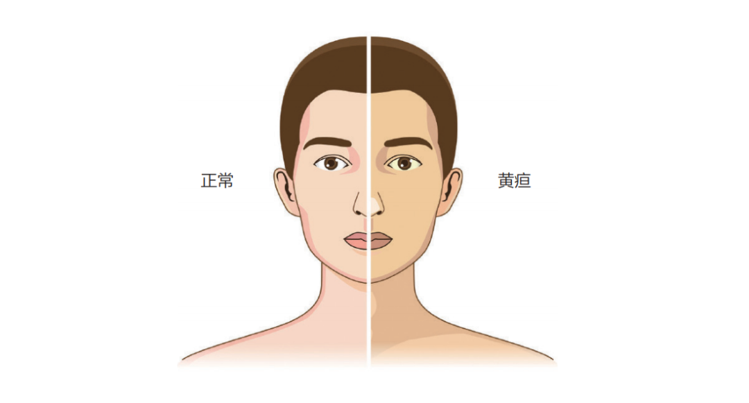 黄疸是怎么回事?不只是皮肤有点黄