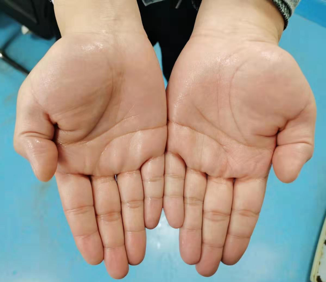 手掌常年“汗如雨下” 竟是一台胸腔手术解决困扰？_长江云 - 湖北网络广播电视台官方网站