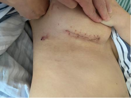 胸腔手术疤痕图片图片