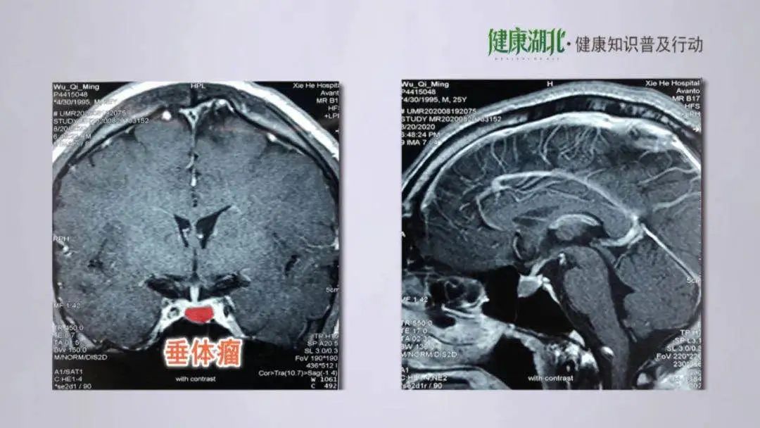 ct扫描3磁共振成像(mri)4气脑和脑血管造影怎样合理治疗垂体瘤?