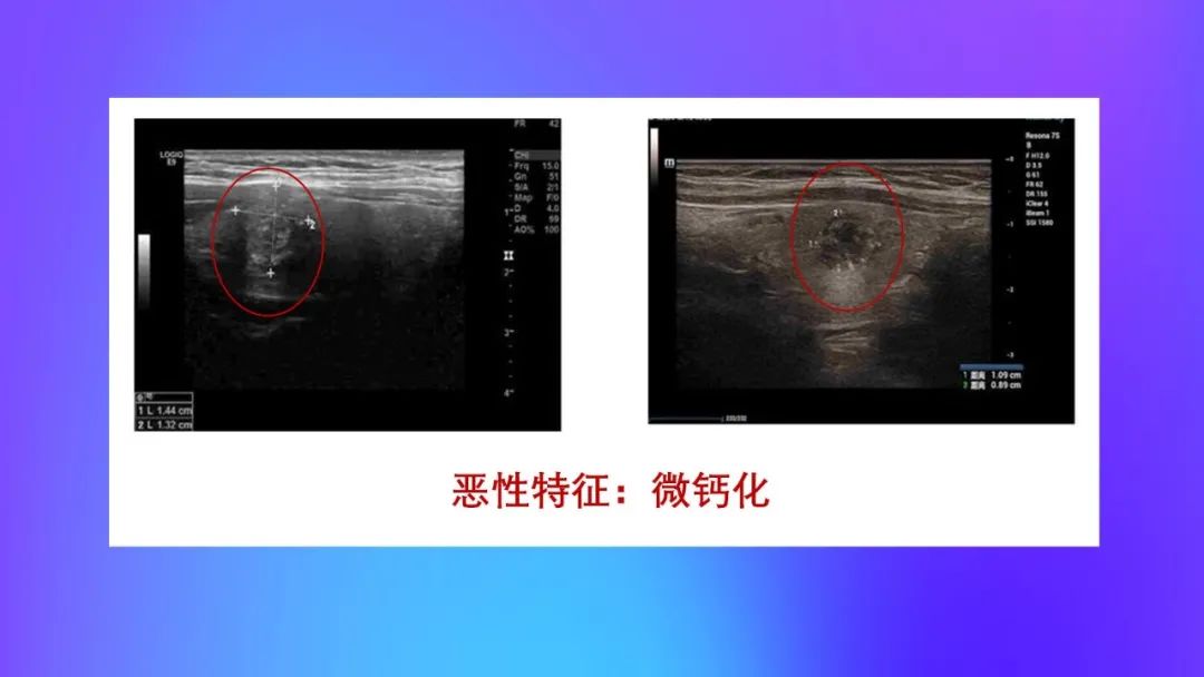 那些年,被我们误解的甲状腺结节
