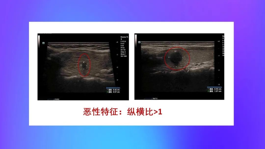 教你一分钟读懂超声报告单,初步判断甲状腺结节的良恶性