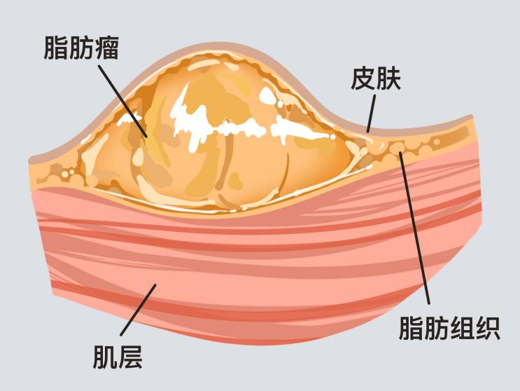 一文带你读懂脂肪瘤!