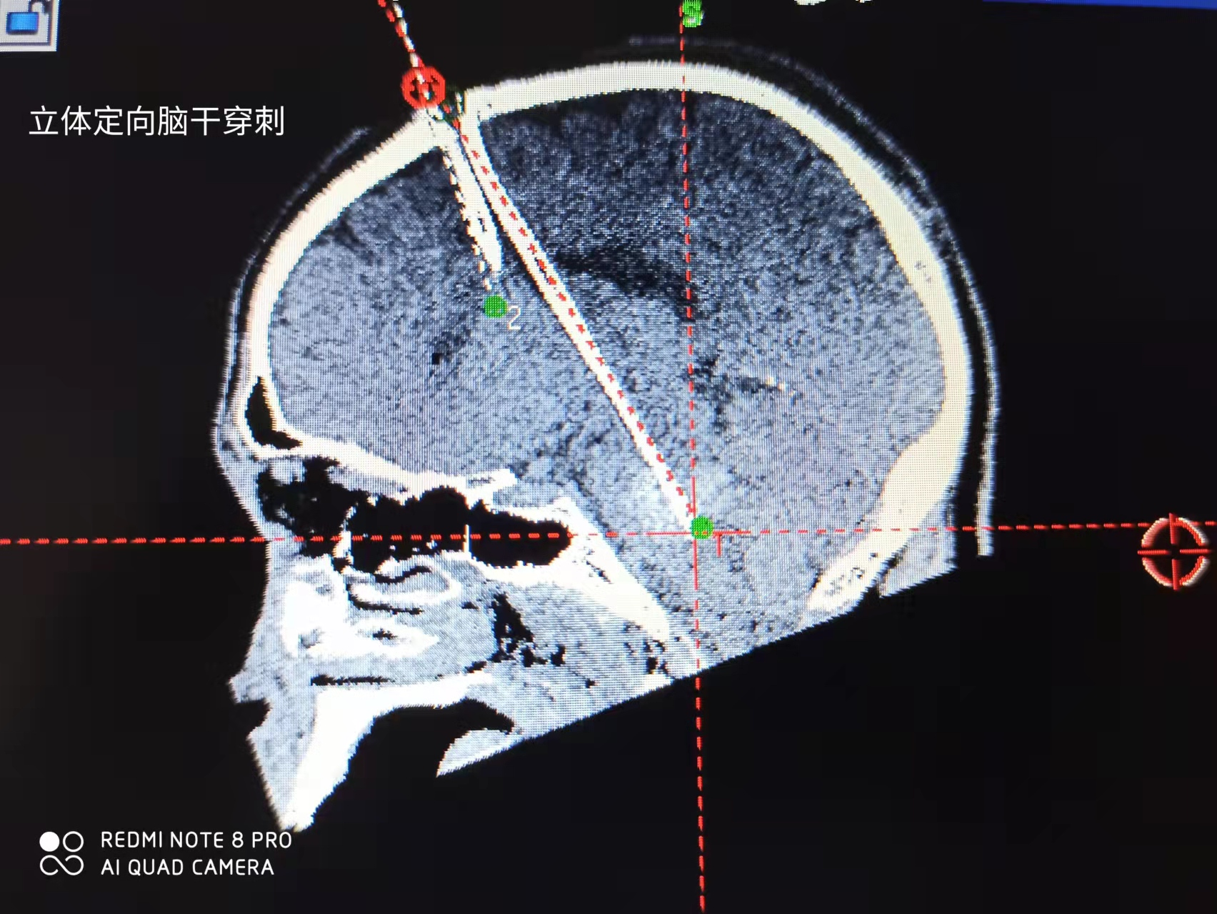 脑干出血ct图片