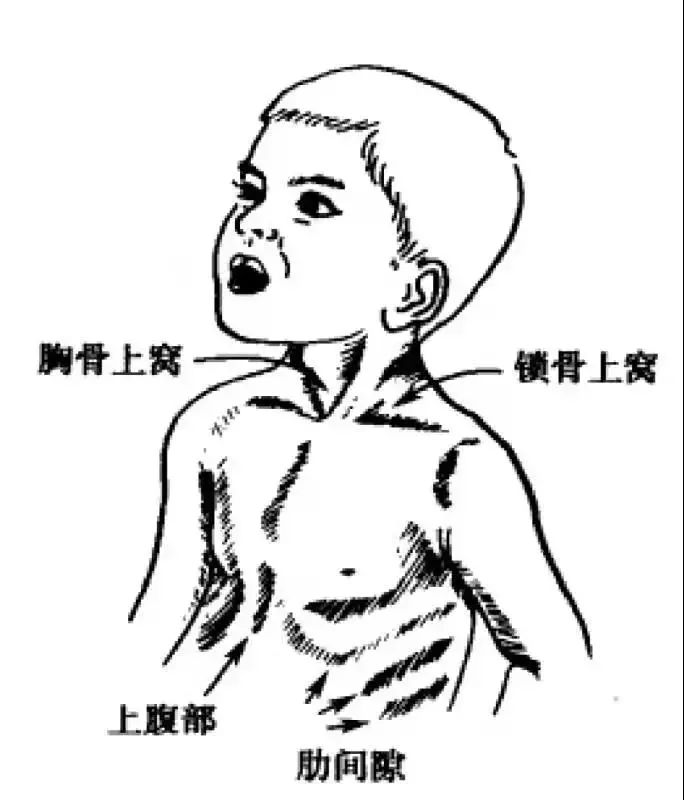 婴儿正常胸骨图片