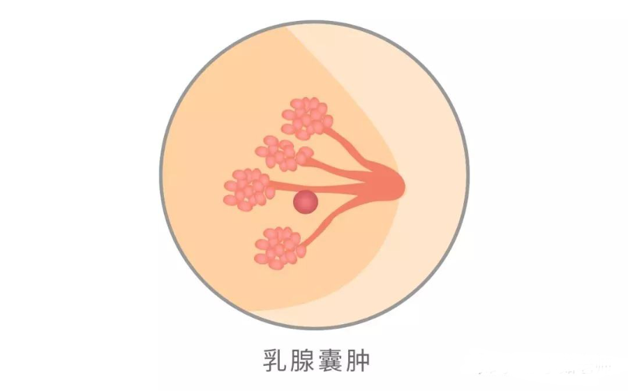 乳腺囊肿的症状图片