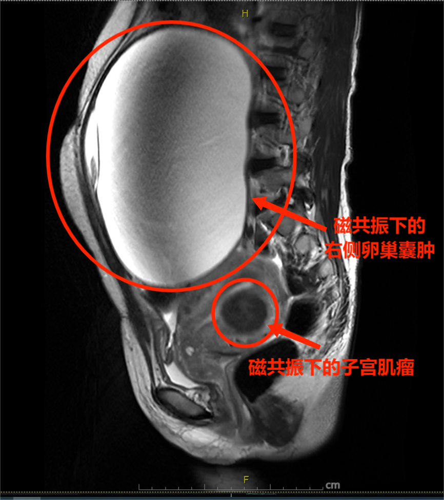 子宫肌瘤小腹变大图片图片