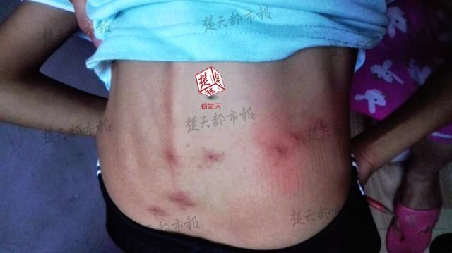 湖北一小学疑现“毒跑道” 近200学生身体不适