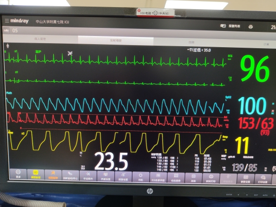 心电监护仪怎么看波形图片