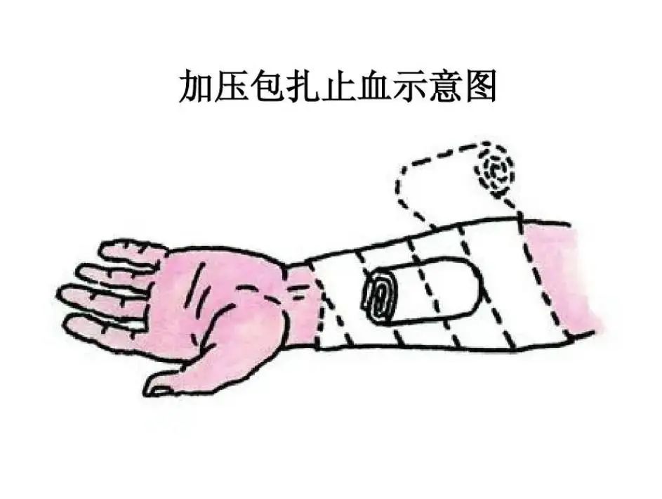遇到意外伤害?止血,包扎,固定,这些技能关键时候能救命!