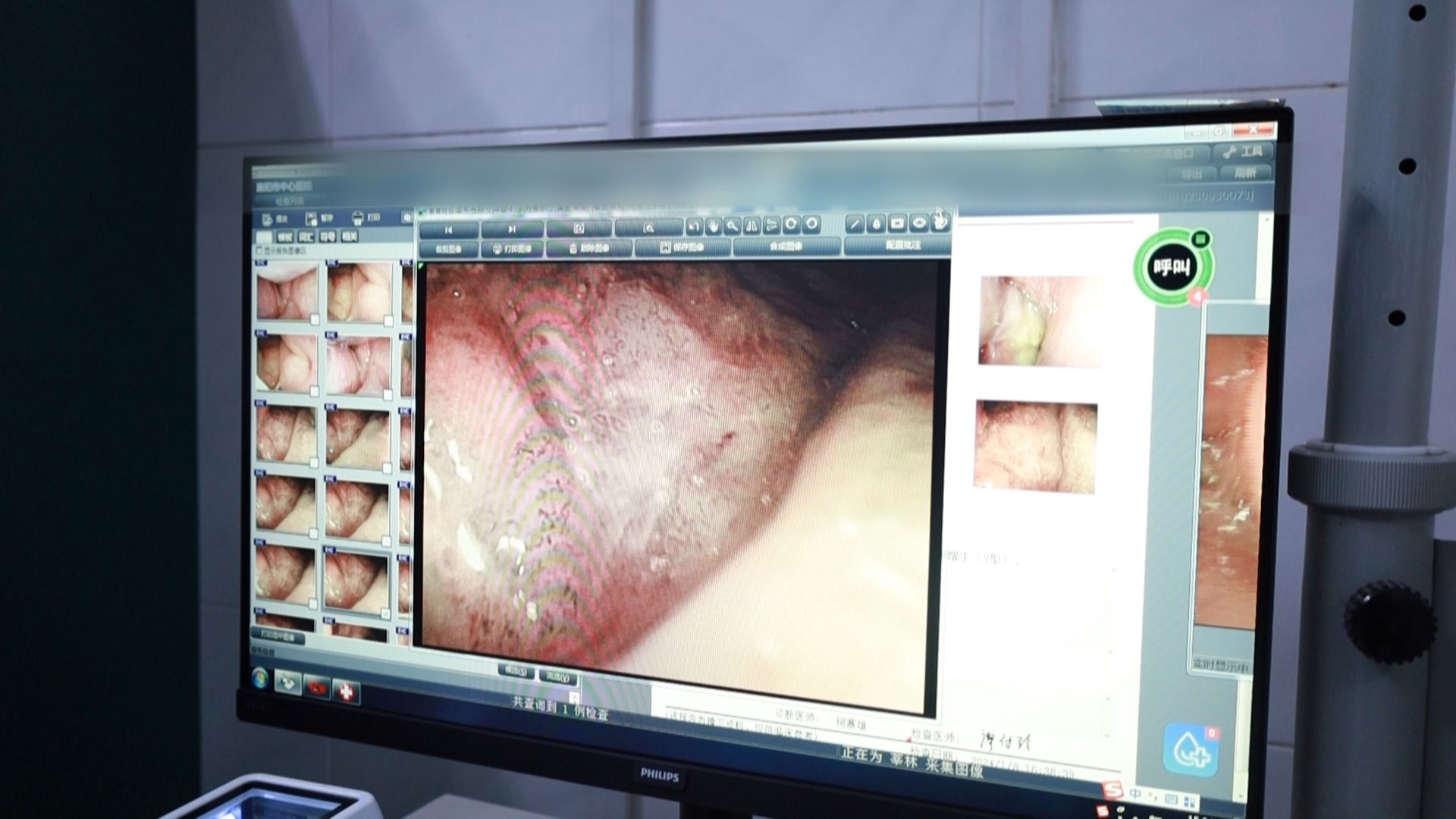 电子喉镜怎么操作每日一方｜NBI电子鼻咽喉镜—耳鼻吼科的火眼金睛！_https://www.jmylbn.com_新闻资讯_第2张