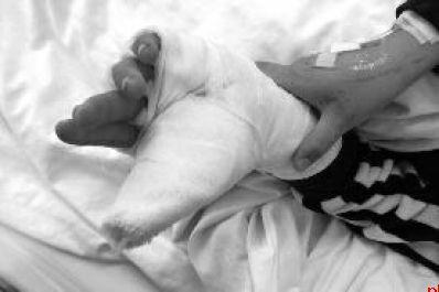 9岁娃自断手指 因自觉受委屈断指表达不满