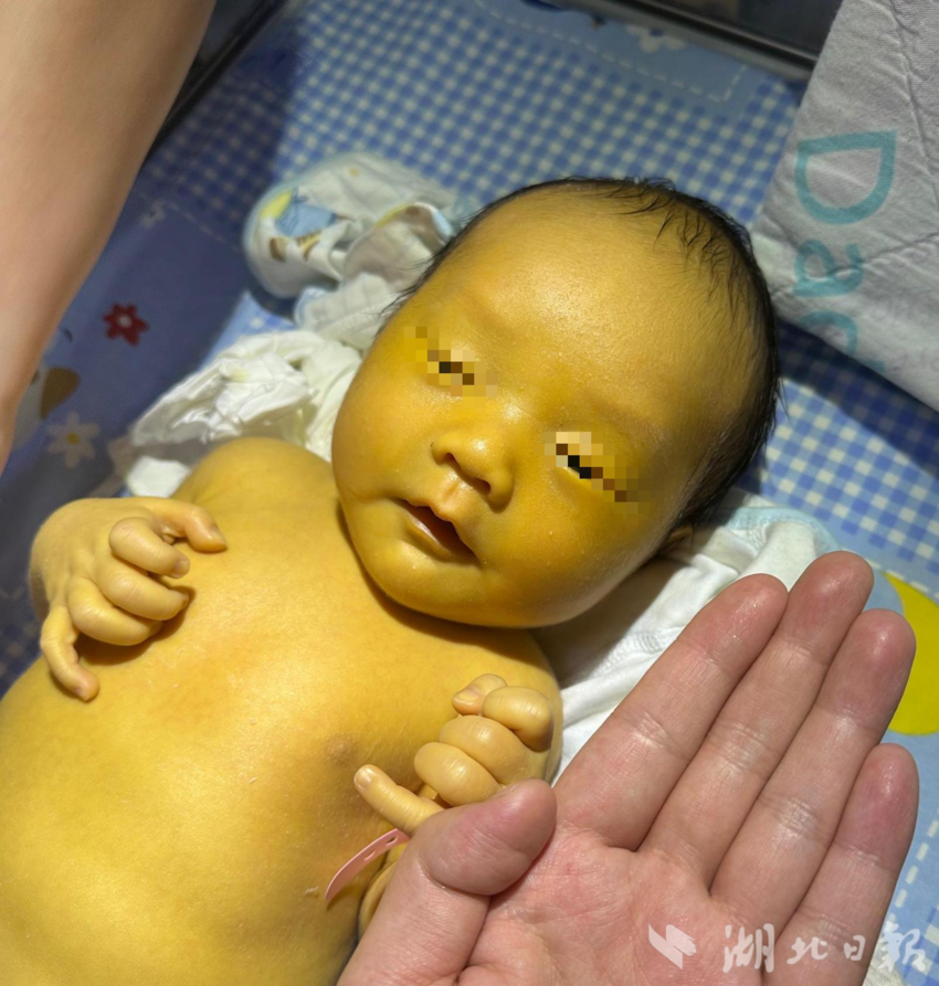 初生宝宝确诊"蚕豆病" 十堰人医专家为其全身大换血