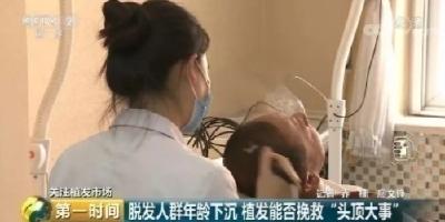 “秃”如其来！我国脱发人群超2.5亿 每6人有1人脱发