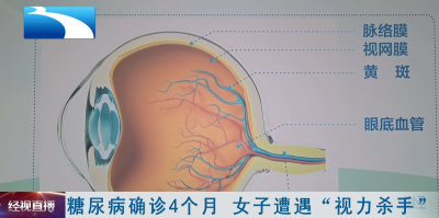 糖尿病确诊4个月  女子遭遇“视力杀手”