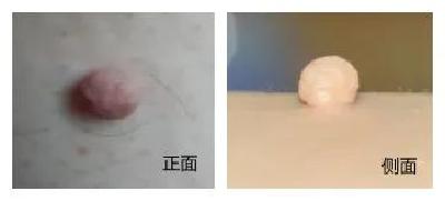 老年朋友注意了！身上长的“小肉粒”都是什么？千万别抠！