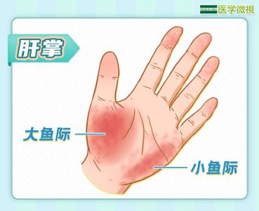 这几种肝病征兆，大多数人都不知道！建议收藏