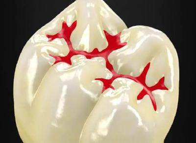 3岁了，要不要给孩子做窝沟封闭？？？