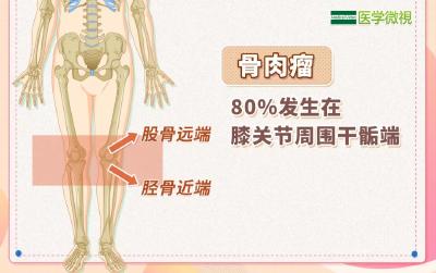 出现不明原因的膝盖痛，一定要警惕这种恶性肿瘤！