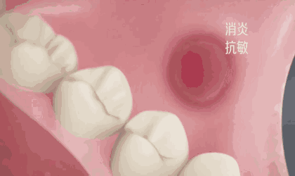 一顿火锅一时爽！一直火锅？口腔溃疡！