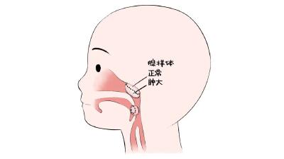 孩子脾气差，睡不安稳，元凶原来是腺样体肥大