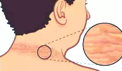 孩子脖子发黑，竟然是肥胖引起的