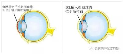  散光是什么？有散光能做近视手术吗？