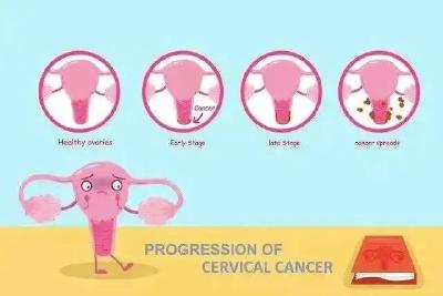 99% 的宫颈癌与 HPV 感染有关，看完后悔没早打！