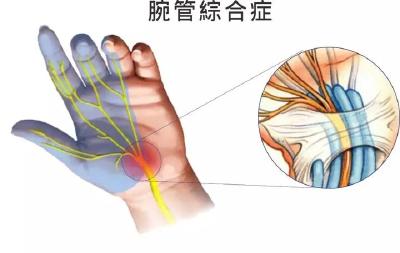 做家务、刷手机，还会得上这个病？！