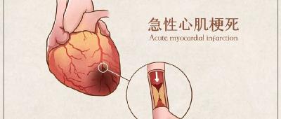  冬季急性心梗的防治