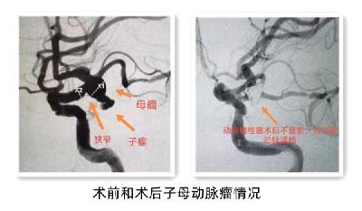 眼皮下垂，没想到是脑动脉瘤作祟