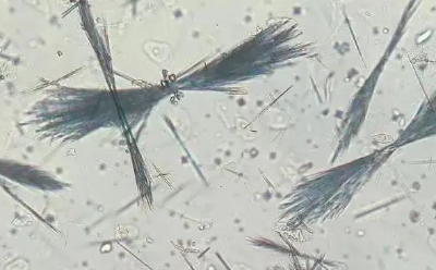 尿里藏“针”，尿酸盐结晶不容忽视