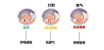 打呼噜说明睡得香？出现这些情况要当心！