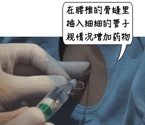 全麻手术会不会变傻？麻醉时经历了什么？