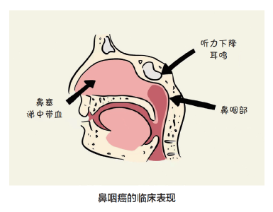 耳闷，可能是癌！想不到的耳科疾病