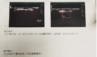 每天截屏数百次，她的手指“肿”了，赶紧看看你自己的