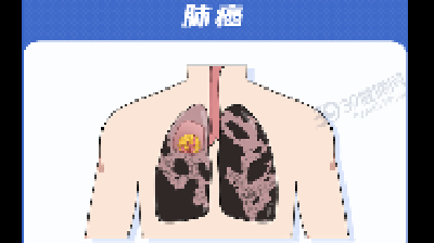 为什么癌症更爱这5种人？就凭这几点...