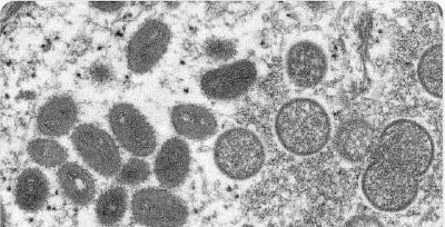 法国约1700人感染猴痘 多数感染发生在巴黎地区