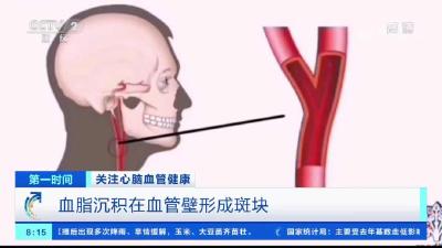 我国约2亿人有颈动脉斑块！严重吗？会有脑梗风险吗