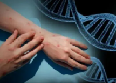 美国宣布猴痘疫情为突发公共卫生事件