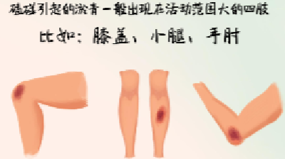 身上青紫？当心突然出现的淤青！