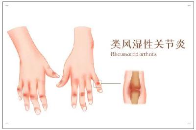 关于类风湿性关节炎，你需要知道......