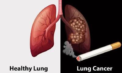 为何肺癌一发现就是晚期？提醒：双腿若有2个异常，留心肿瘤侵袭