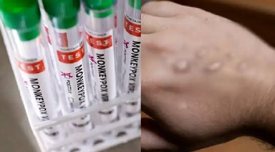 世卫组织：全球已报告超过7万例猴痘病例